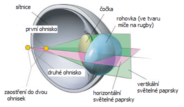 Astigmatismus
