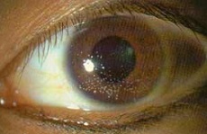 kontaminace oka Acanthamoebou