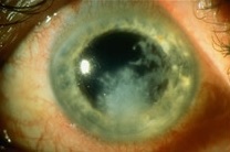 oko s plísňovou infekci